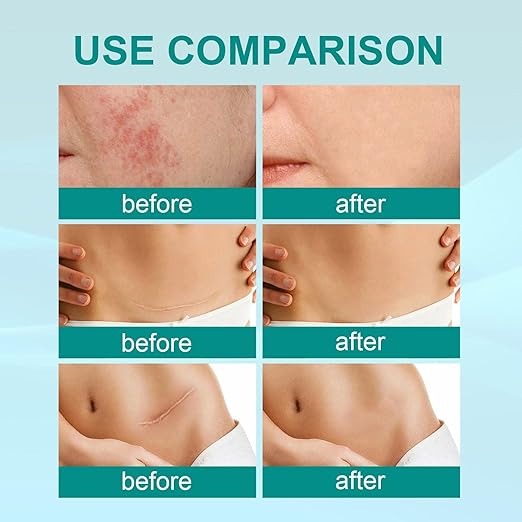 Scar Removal Spray | بخاخ إزالة الندبات
